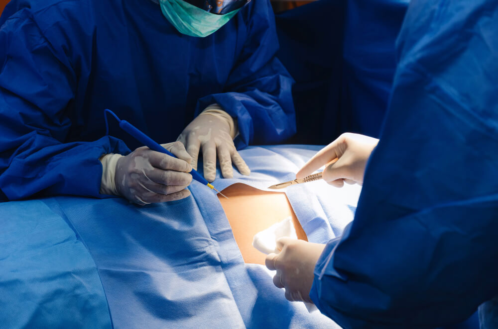 Precio de la Apendicectomía en CDMX